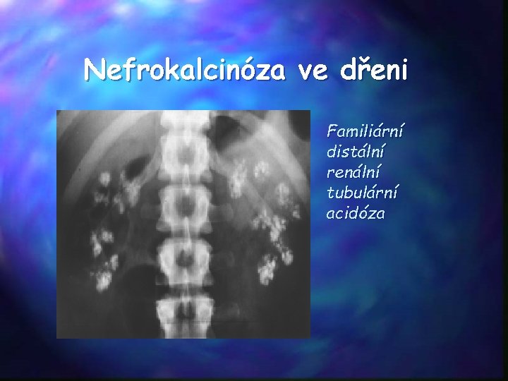 Nefrokalcinóza ve dřeni Familiární distální renální tubulární acidóza 
