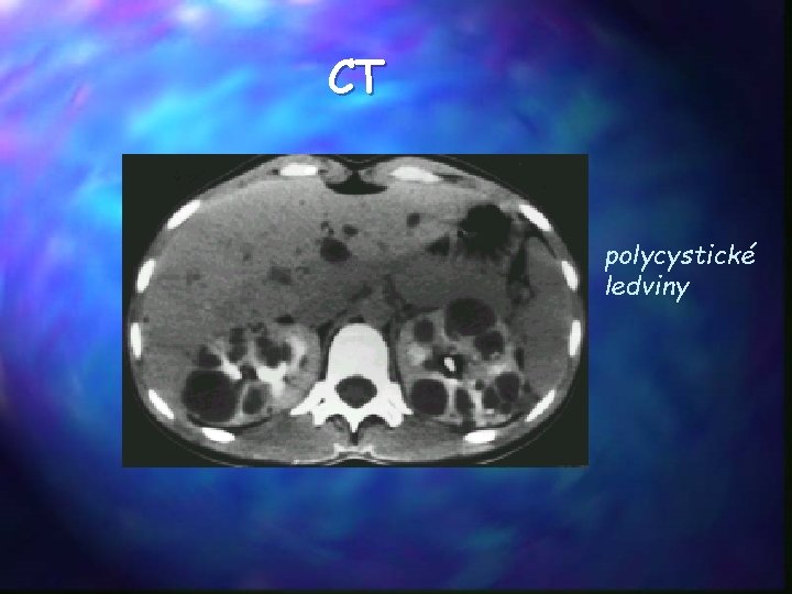 CT polycystické ledviny 