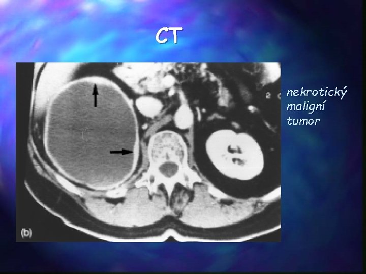 CT nekrotický maligní tumor 