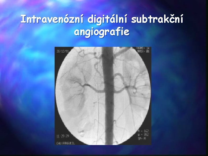 Intravenózní digitální subtrakční angiografie 