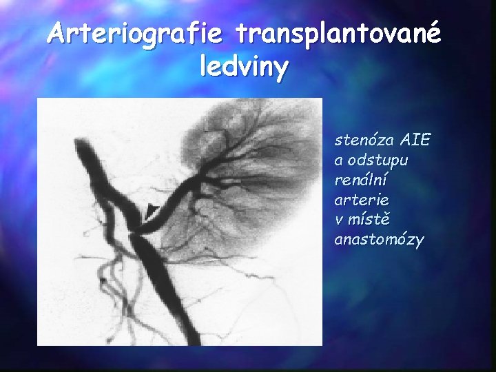 Arteriografie transplantované ledviny stenóza AIE a odstupu renální arterie v místě anastomózy 