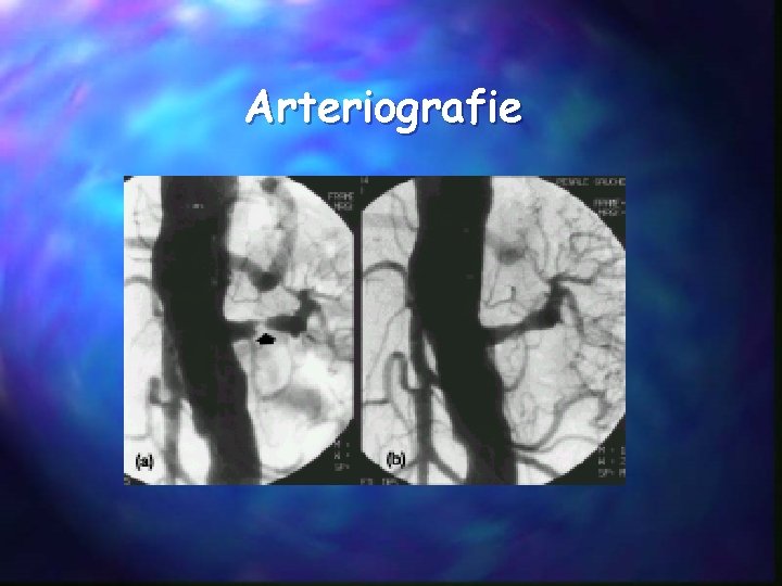 Arteriografie 