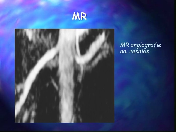 MR MR angiografie aa. renales 