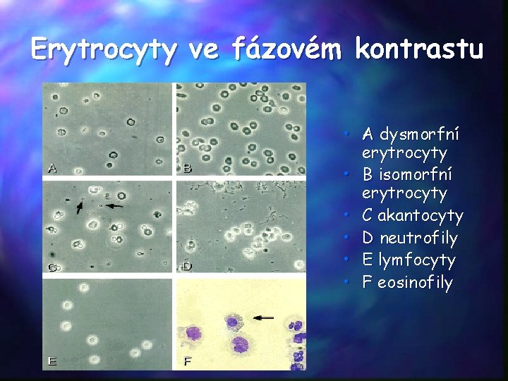 Erytrocyty ve fázovém kontrastu • A dysmorfní erytrocyty • B isomorfní erytrocyty • C