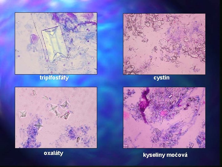 triplfosfáty oxaláty cystin kyseliny močová 
