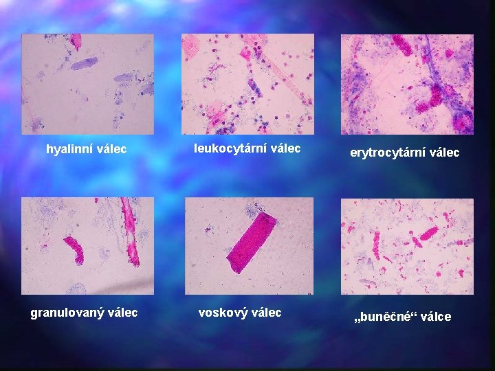 hyalinní válec granulovaný válec leukocytární válec voskový válec erytrocytární válec „buněčné“ válce 