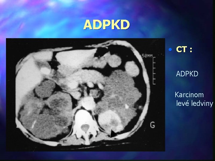 ADPKD • CT : ADPKD Karcinom levé ledviny 