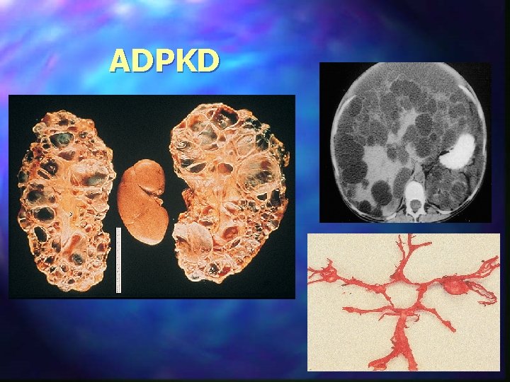 ADPKD 