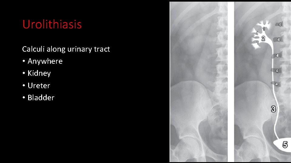 Urolithiasis Calculi along urinary tract • Anywhere • Kidney • Ureter • Bladder 