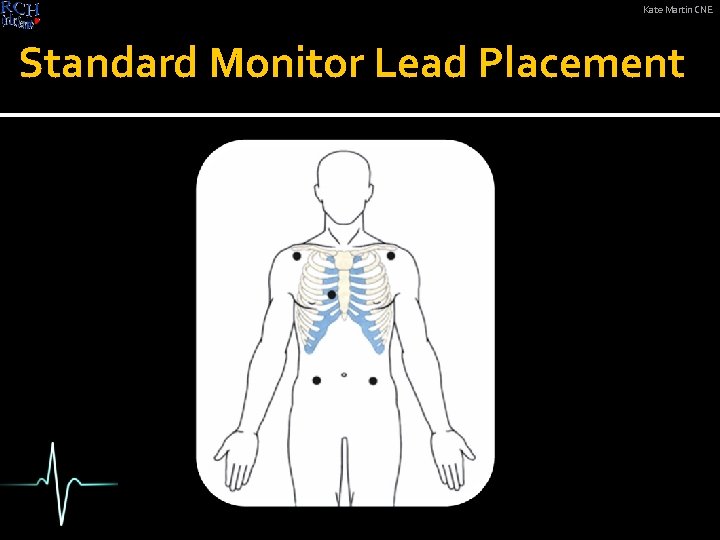 Kate Martin CNE Standard Monitor Lead Placement 