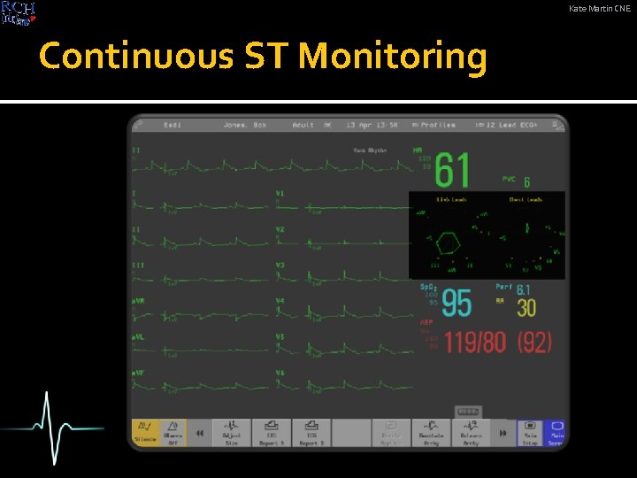Kate Martin CNE Continuous ST Monitoring 