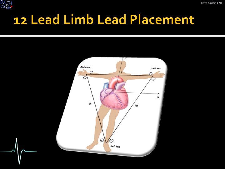 Kate Martin CNE 12 Lead Limb Lead Placement 