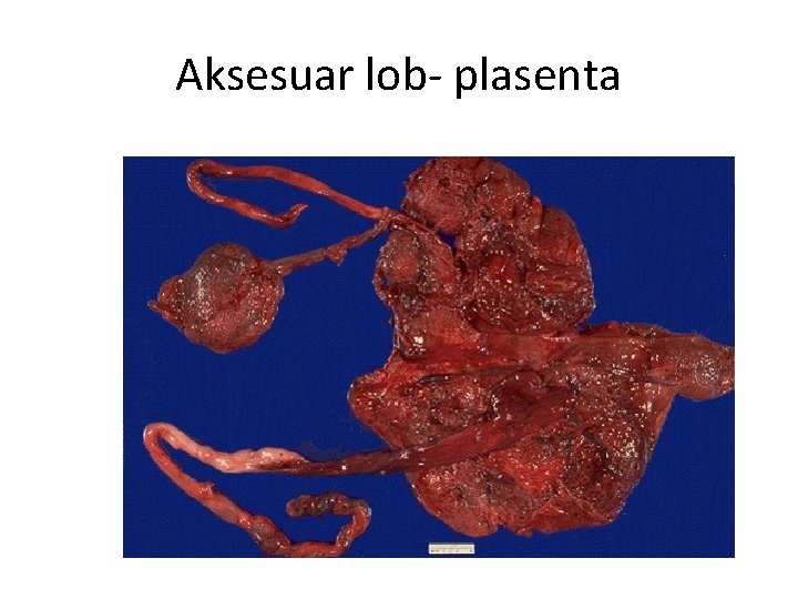 Aksesuar lob- plasenta 