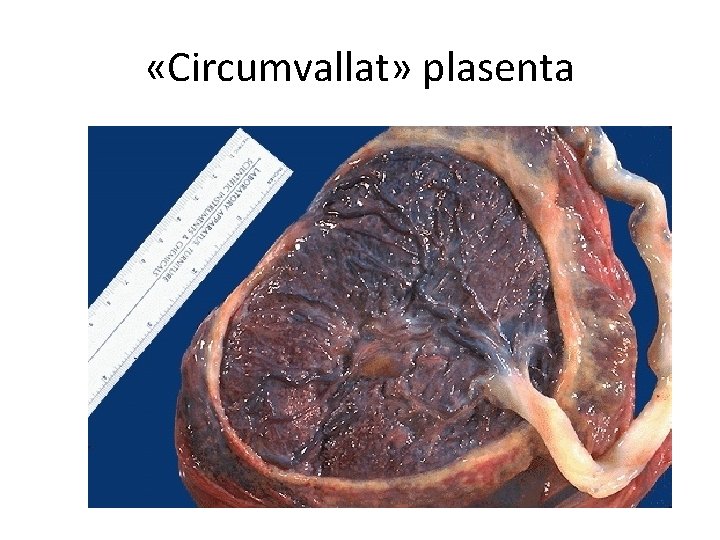  «Circumvallat» plasenta 