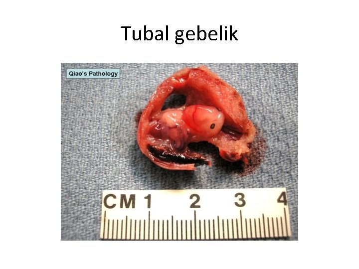 Tubal gebelik 