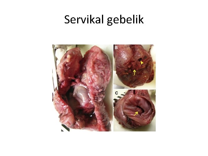 Servikal gebelik 