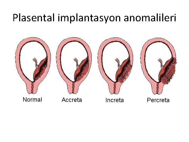 Plasental implantasyon anomalileri 