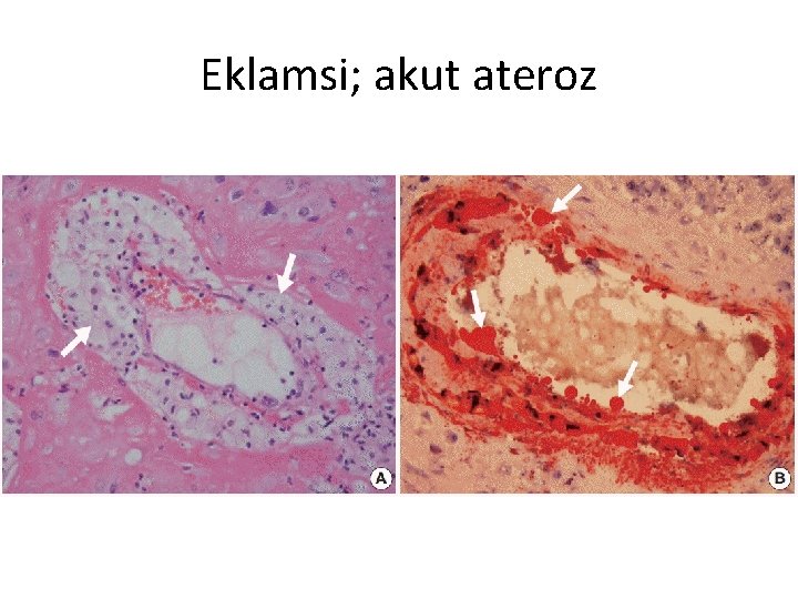 Eklamsi; akut ateroz 