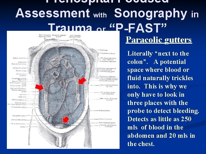 Prehospital Focused Assessment with Sonography in Trauma or “P-FAST” Paracolic gutters Literally “next to