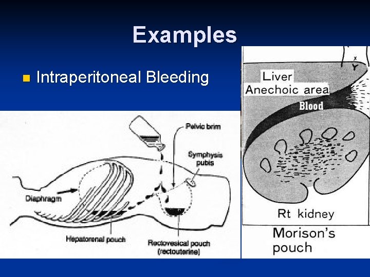 Examples n Intraperitoneal Bleeding 