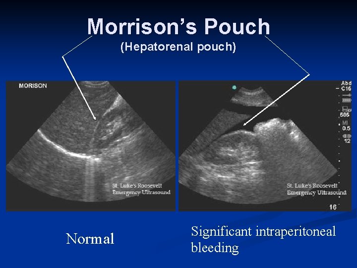 Morrison’s Pouch (Hepatorenal pouch) Normal Significant intraperitoneal bleeding 