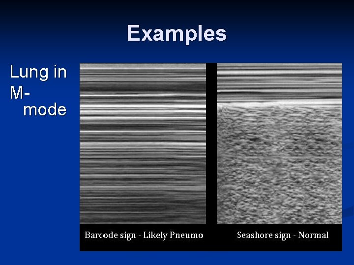 Examples Lung in Mmode 