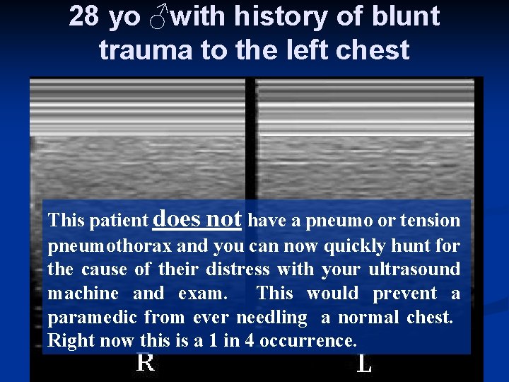 28 yo ♂with history of blunt trauma to the left chest Pt is SOB,