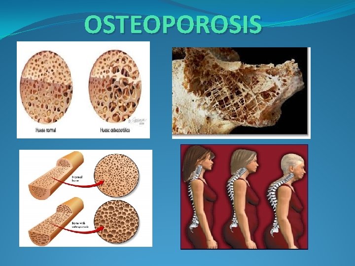 OSTEOPOROSIS 