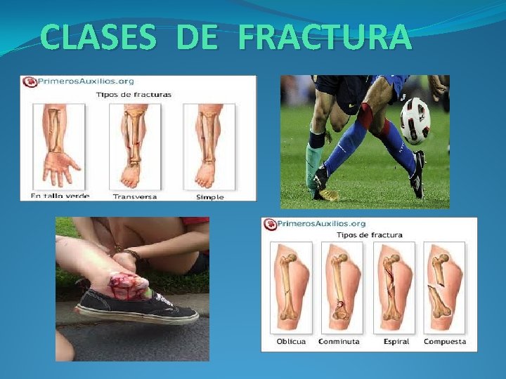 CLASES DE FRACTURA 