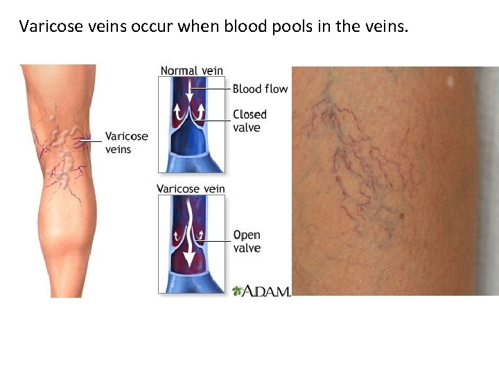Varicose veins occur when blood pools in the veins. 