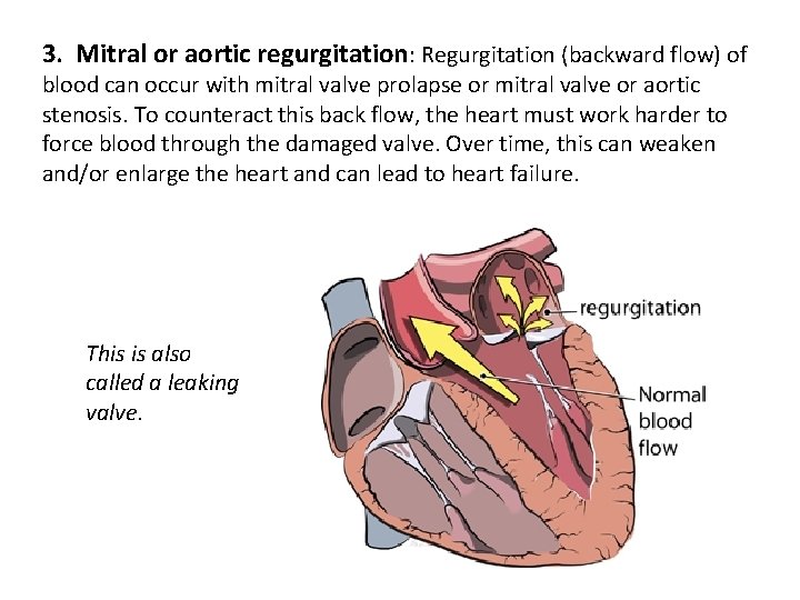 3. Mitral or aortic regurgitation: Regurgitation (backward flow) of blood can occur with mitral
