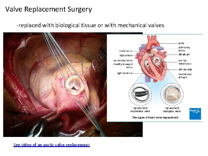 Valve Replacement Surgery -replaced with biological tissue or with mechanical valves See video of