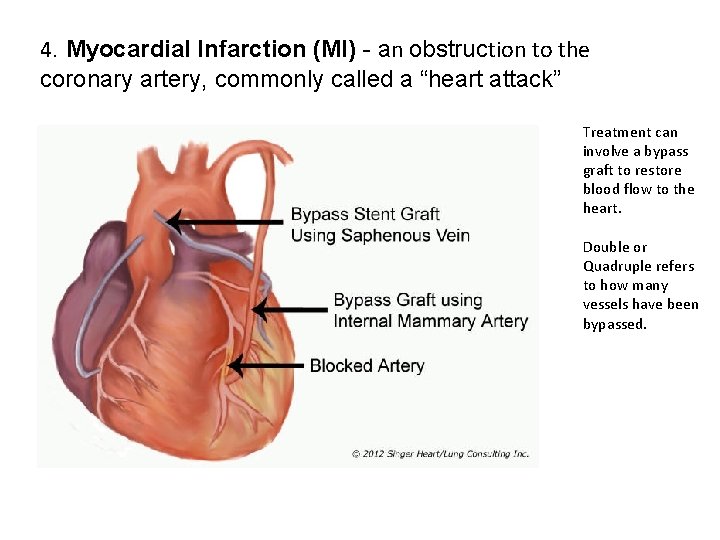 4. Myocardial Infarction (MI) - an obstruction to the coronary artery, commonly called a