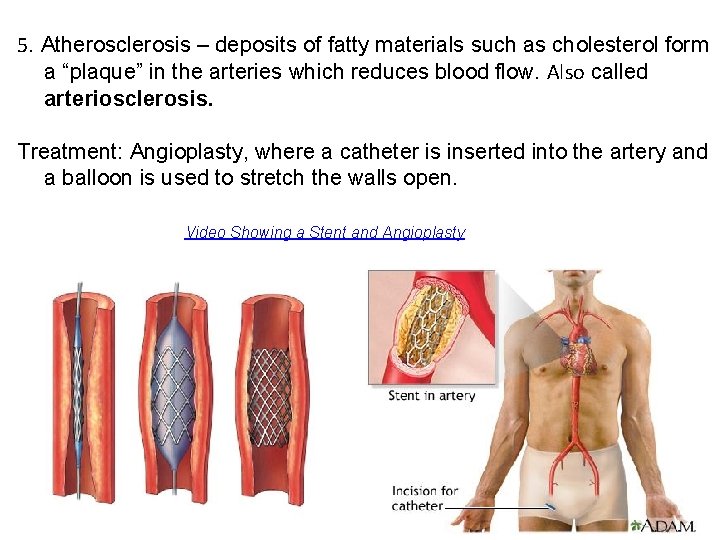 5. Atherosclerosis – deposits of fatty materials such as cholesterol form a “plaque” in