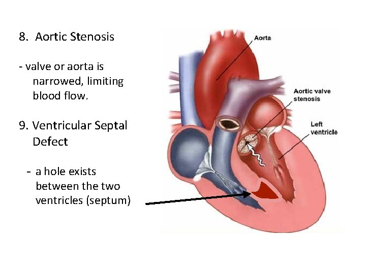 8. Aortic Stenosis - valve or aorta is narrowed, limiting blood flow. 9. Ventricular
