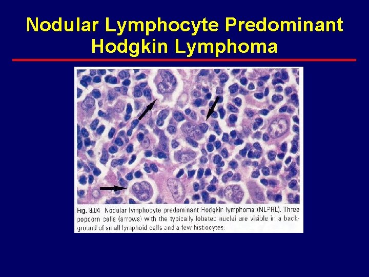 Nodular Lymphocyte Predominant Hodgkin Lymphoma 
