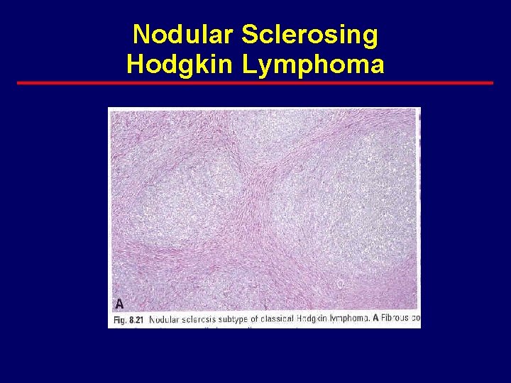 Nodular Sclerosing Hodgkin Lymphoma 