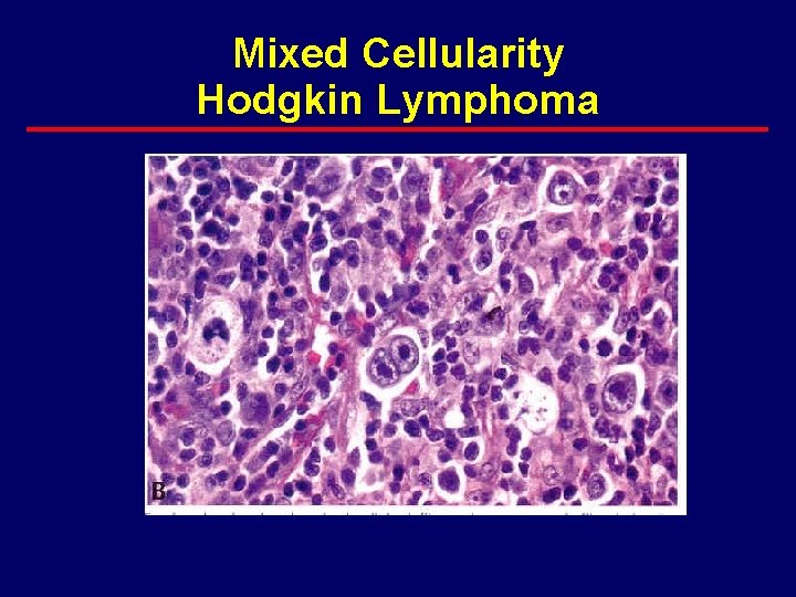 Mixed Cellularity Hodgkin Lymphoma 