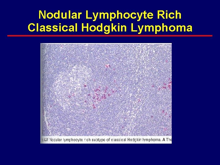 Nodular Lymphocyte Rich Classical Hodgkin Lymphoma 