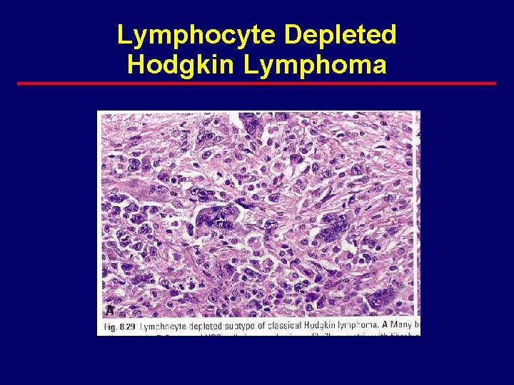 Lymphocyte Depleted Hodgkin Lymphoma 