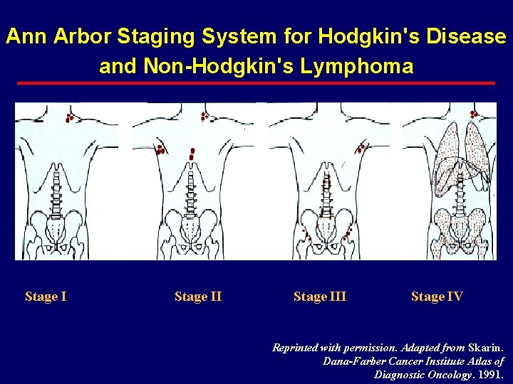 Ann Arbor Staging System for Hodgkin's Disease and Non-Hodgkin's Lymphoma Stage III Stage IV