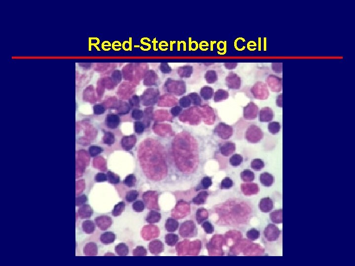 Reed-Sternberg Cell 