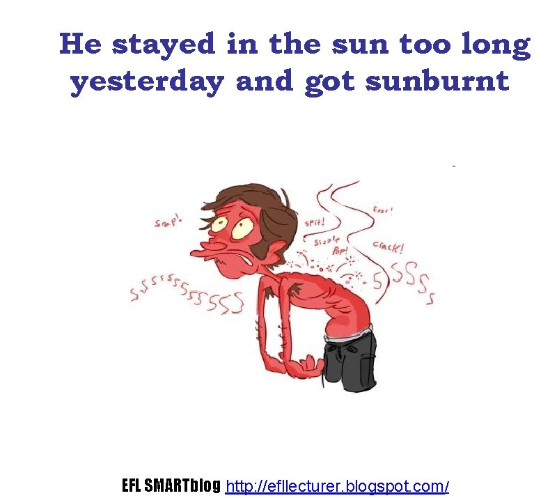 He stayed in the sun too long yesterday and got sunburnt EFL SMARTblog http: