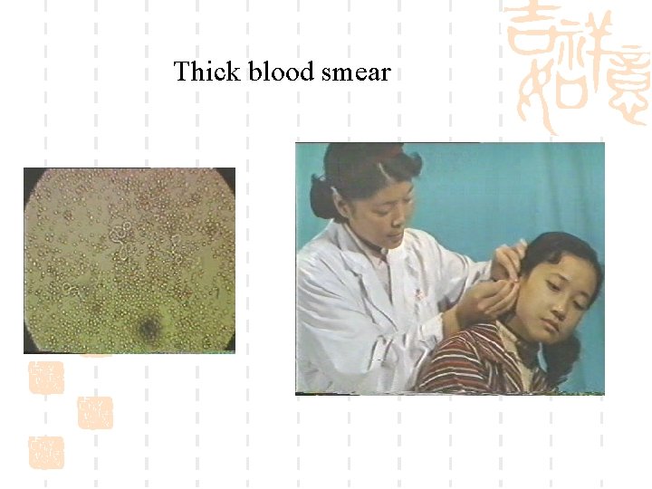 Thick blood smear 