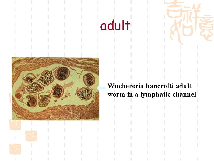 adult Wuchereria bancrofti adult worm in a lymphatic channel 