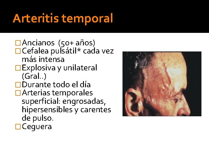 Arteritis temporal �Ancianos (50+ años) �Cefalea pulsátil* cada vez más intensa �Explosiva y unilateral