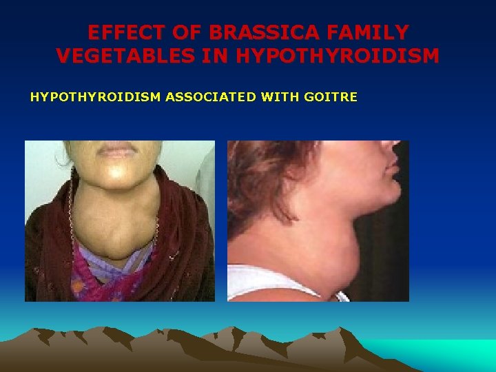 EFFECT OF BRASSICA FAMILY VEGETABLES IN HYPOTHYROIDISM ASSOCIATED WITH GOITRE 