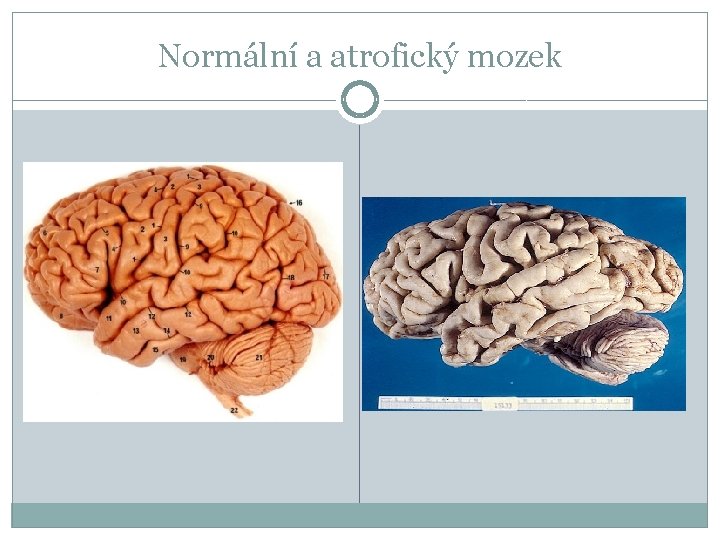 Normální a atrofický mozek 