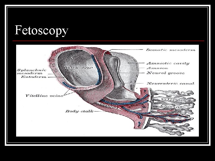 Fetoscopy 