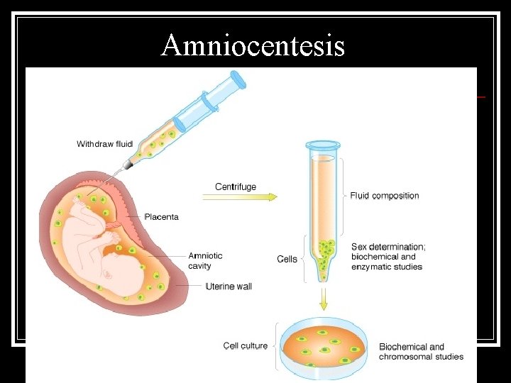 Amniocentesis 